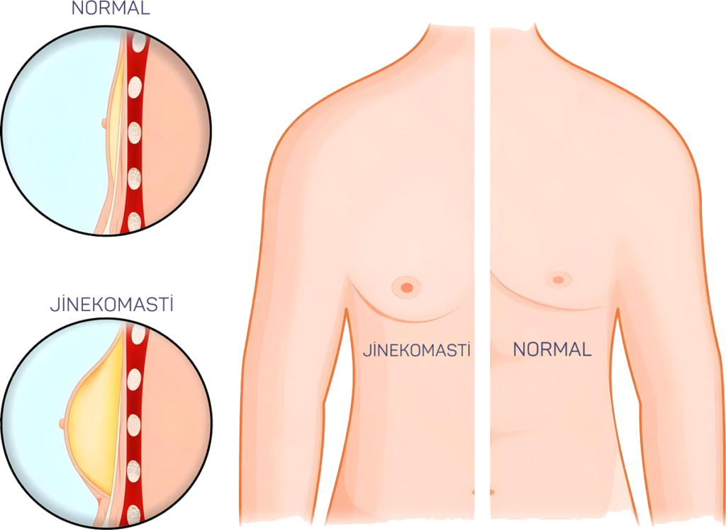 Normal - Jinekomasti gögüs görünümü