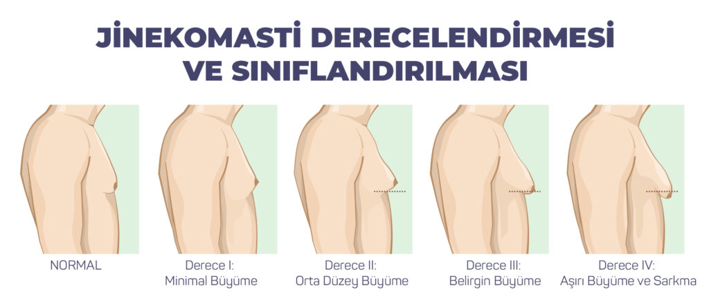 Jinekomasti Derecelendirmeleri ve Sınıflandırılması